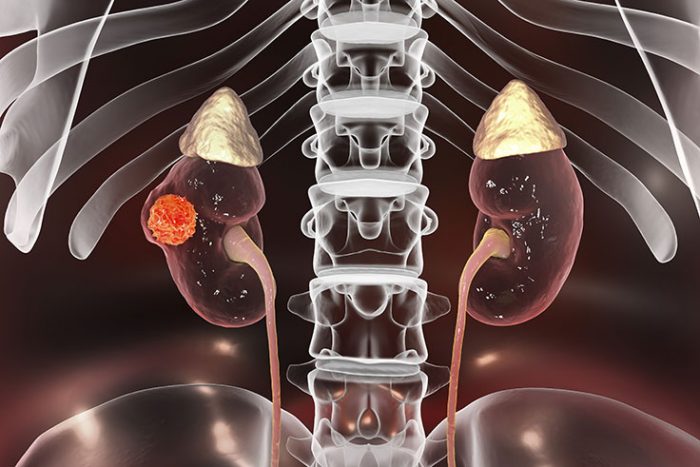 Does Kidney Cancer Show Up In Blood Tests